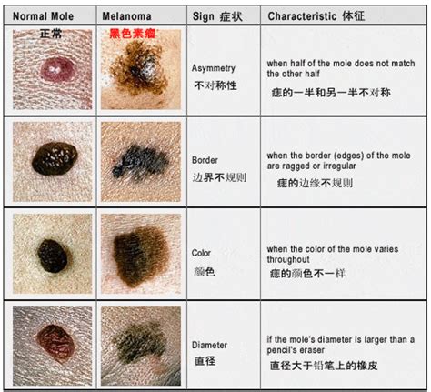 突出來的痣